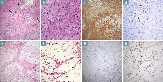a The first tumor is a hypercellular astrocytic neoplasm that exhibits hyperchromatic, pleomorphic, and irregular nuclei. The tumor cells show infiltration of the brain tissue with scattered foci of necrosis (arrows, H&E. ×100). b This malignant glioma exhibits many gemistocytic cells with abundant eosinophilic cytoplasm (arrowheads) and easily detectable mitoses (arrow, H&E. ×400). c GFAP immunohistochemical study highlights the tumor cells (GFAP, ×400). d The Ki-67 proliferative index is increased in multiple tumor areas (Ki-67, ×100). e The second tumor is a soft tissue neoplasm with cellular and hypocellular areas, abundant myxoid background, and areas of necrosis (arrows). The cells are pleomorphic and exhibit round-to-spindle, hyperchromatic, and atypical nuclei (H&E. ×100). f A High-power view of the tumor shows a rich myxoid stroma and elongated curvilinear thin blood vessels and has easily detectable mitoses (H&E. ×200). g GFAP immunohistochemical study is negative (GFAP, ×100). h This tumor’s Ki-67 proliferative index is markedly high (Ki-67, ×100).