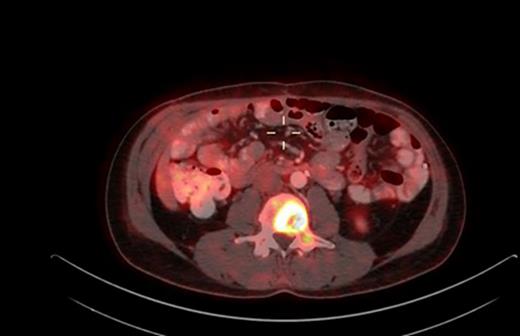 September 2021, PET-CT axial view, L3.