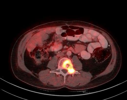 December 2021, PET-CT axial view, L3 showing progressive disease in left transverse pedicle and left lamina.