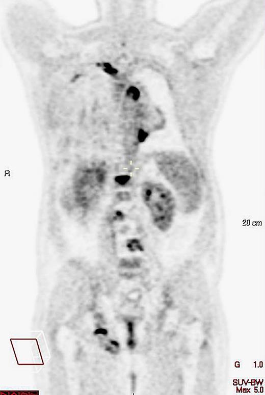 December 2021, PET-CT coronal view, L2–L4 progression.