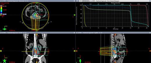 May 2022, re-radiation treatment planning. Red color 40 Gy, blue −30 Gy treatment planning volumes.