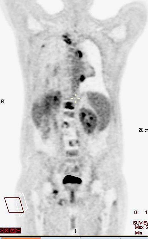 November 2022, PET-CT coronal view, response in L2–L4.