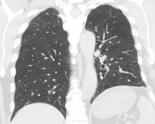 CT scan showing innumerable pulmonary nodules and irregular nodular opacities throughout the lungs. CT, computed tomography.