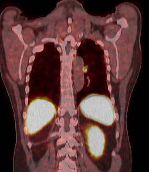 PET scan showing multiple nodules in the left lung exhibiting variable degrees of abnormally increased tracer activity. PET, positron emission tomography.