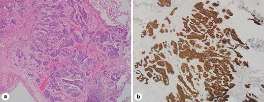 a Hematoxylin and eosin stain showing pulmonary neuroendocrine cell hyperplasia (×100 magnification). b Immunohistochemical staining showing lesional cells positive for chromogranin.