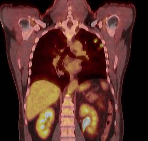 PET scan showing bilateral pulmonary nodules overall similar in size with an uptake similar to or slightly higher than the blood pool. The nodule with the most avid radiotracer is within the superior and medial left lower lobe, measuring up to 15 mm. PET, positron emission tomography.