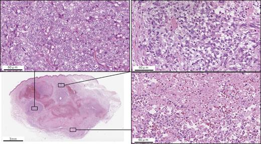 Specimen from the primary tumor: most of the tumor was necrotic lesion with scattered active lesions composed of a massive proliferation of atypical clear, balloon-like cells.