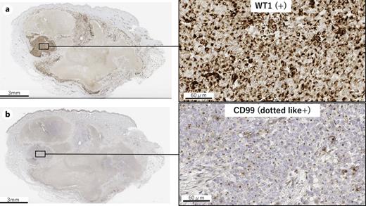 Immunohistochemical staining at tumor sites: balloon-like tumor cells were positive for WT1 and CD99.