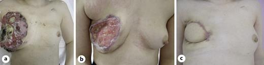 Local findings. a A 17 cm-sized exposed tumor covered with pus, necrotic tissue, and mucus occupied the whole right breast before chemotherapy. b Marked tumor shrinkage and large skin defect were observed after chemotherapy. c Skin defect was well covered with the LDMC flap.