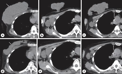 Computed tomography (CT) findings. Before chemotherapy. A large tumor (arrow) was observed on the right chest wall (a). Enlarged lymph nodes were observed in the axilla (b: arrows) and parasternum (c: arrow). After chemotherapy, marked tumor shrinkage was observed (d: arrow). Enlarged lymph nodes in the axilla (e: arrows) and parasternum (f: arrow) showed no change in size.