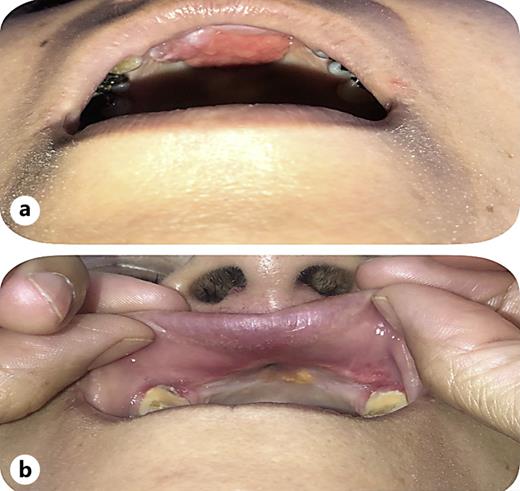 a Clinical picture: lesion at the level of the upper right incisor compatible with IMT. b Clinical picture: complete response after starting treatment with alectinib.
