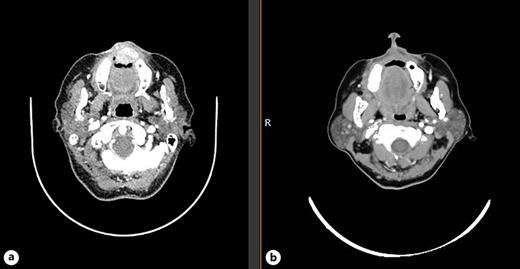 a Computed axial tomography image showing contrast-enhancing nodular lesion that partially occupies the upper vestibule, measuring 22 mm × 17 mm in diameter. January 2018. b Computed axial tomography image showing complete radiological response according to RECIST 1.1 criteria. August 2018.