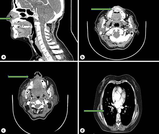 Images of the evolution of target lesion response during treatment. a, b Focal nodular lesion measuring 12 × 13 mm with contrast hyperenhancement, partially occupying the upper vestibule, well defined, slightly heterogeneous. c, d CT scan after 5 months of treatment with alectinib in pathological complete response according to RECIST 1.1 criteria.