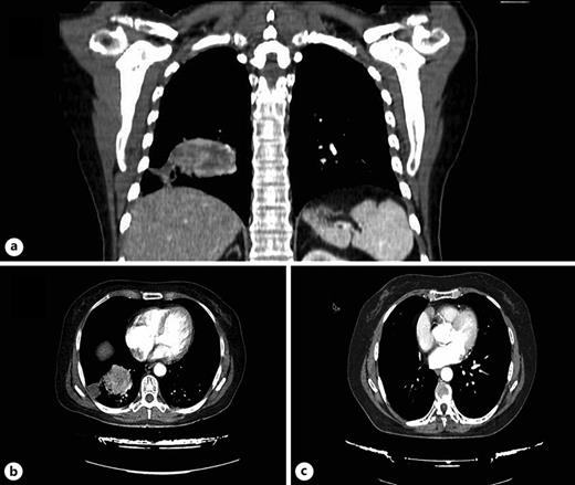 Evolution of the lung metastasis. a, b January 2018, image of mass approximately 56 mm in maximum diameter, located in the right lower lobe. c August 2019, control CT scan after lobectomy.