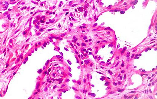 Showing the histological profile of RH with ill-defined vascular channels.