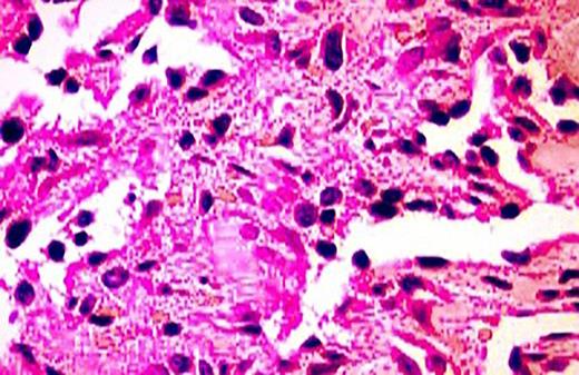 The H&E stain also shows the hobnailing of endothelial channels.