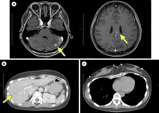 a Multiple small and large enhancing lesions along the sulci and surfaces of the cerebellar hemispheres are observed. In addition, enhancing nodules in the cerebral sickle cells are noted. b Multiple progressively increasing and enlarging metastases in both lobes of the liver are observed. c No contrast nodules and no recurrence within the left breast are observed.