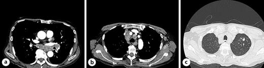 Chest enhanced CT detected left hilar (a) and mediastinal lymphadenopathy (b) and an irregularly shaped nodule in the left upper lobe (c). CT, computed tomography.