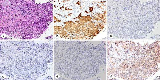 a Pathological examination of needle biopsy taken from the axillary lymph node revealed poorly differentiated adenocarcinoma. Immunohistochemical staining indicated diffuse expression of CK 7 (b) but negative for CK 20 (c), TTF-1 (d) and napsin A (e). f The tumor cells were also positive for PTH-rP.