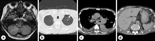 a Magnetic resonance imaging showed brain metastasis. Chest and abdominal CT showed increased size of the nodule in the upper lobe of the left lung (b), bilateral pleural effusion (c), and ascites (d) 15 days after admission. CT, computed tomography.