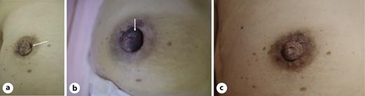 Pre- and postoperative nipple findings. a Slight but obvious nipple retraction (arrow) was observed in the right breast. b Superficial dermal necrosis of the nipple (arrow) was observed shortly after the operation. c When the necrotic superficial epidermis peeled off, the nipple completely returned to its preoperative condition.