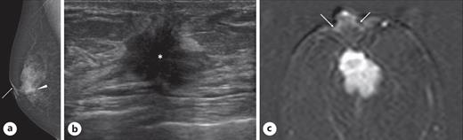 Preoperative breast images. a Mammography showed focal asymmetric density just under the nipple (arrowhead) and slight nipple retraction (arrow). b Ultrasonography showed an irregular mass (asterisk) without any haloes under the nipple-areolar complex. c Magnetic resonance imaging showed a well-circumscribed mass neither with stromal invasion nor with ductal spreads to the slightly retracted nipple-areolar complex (arrows).