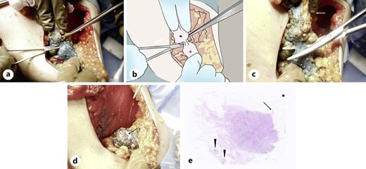 Nipple base resection techniques and postoperative pathological findings. a Sub-nipple mammary gland (arrow) was completely skeletonized using the curved mosquito forceps after the quasi-complete skin flap creation. b This schema is an easy-to-understand representation of (a). Due to traction of the mammary gland (closed circle) containing the breast cancer, the nipple base is slightly sunken below skin level. The mosquito forceps are present below the mammary gland at the level of the lactiferous sinus. c Nipple base resection was done using the Mayo scissors on pulling the mammary gland in the opposite direction of the nipple (arrow). d Nipple base seemed depressed (arrow) as if a hole had been dug in after the nipple base resection. e Low magnified view showed neither stromal invasion nor ductal spreads to the sub-nipple margin (asterisk). Although noninvasive cancer foci (arrowheads) were observed under the tumor, fibrous tissue (arrow) with no cancer spreads was observed in the subareolar region.