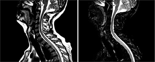 MRI at immune-related myelitis diagnosis. Focal areas of myelitis in the spinal cord, extending longitudinally from C7 to T3 at the cervicothoracic level can be seen. A subtle contrast enhancement is also observed in the periphery of the spinal cord from C4 to T3 at the cervical level.