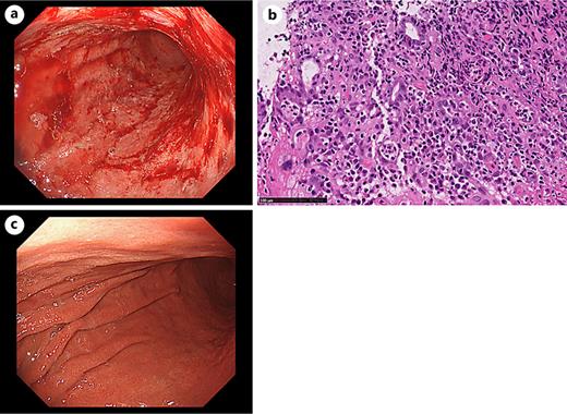 a Esophagogastroduodenoscopy (EGD) revealed hemorrhagic gastroenteritis, with edematous, hyperemic gastric mucosa, diffuse erosion, and active blood oozing. b, c EGD after 1 month of systemic steroid therapy showed improvement in gastritis.