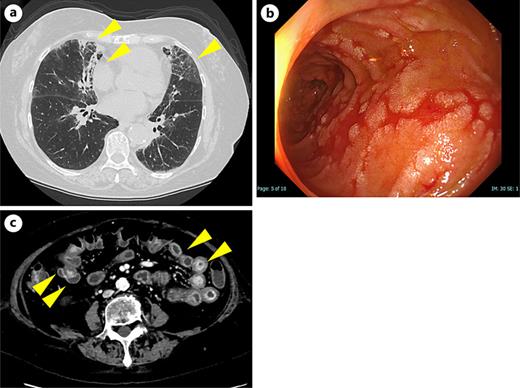 a Chest CT after pembrolizumab re-administration showed ground-glass shadows and reticular shadow in both lungs (arrow heads). b, c Endoscopic findings revealed gastritis and contrast-enhanced CT showed thickened intestinal walls (arrowheads) 2 months after the last pembrolizumab dose, while the patient was on 10 mg of prednisolone.
