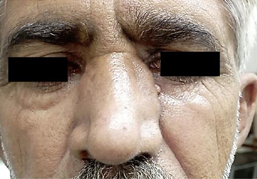 Swelling of nasal bridge and increased intercanthal distance.