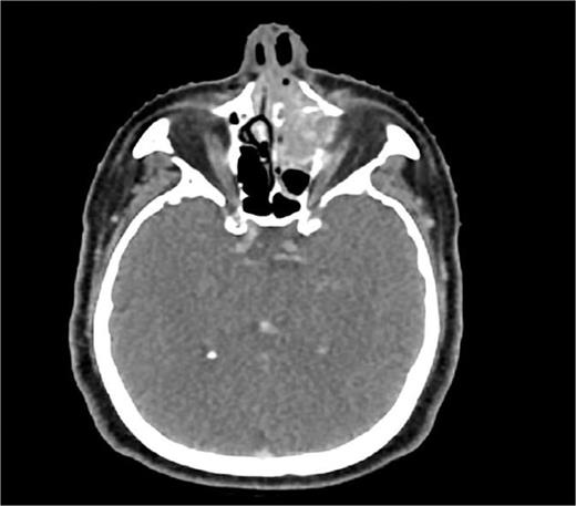 CT scan of paranasal sinuses (axial view) showing a hyperdense expansile mass involving left-sided nasal cavity and maxillary sinus.