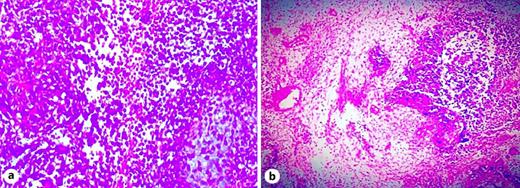 a, b Histopathological analysis of tumor sample taken through biopsy showing the mesenchymal areas displayed spindled cells with myxoid changes along with primitive neuroepithelial elements formed small blue cell nests.