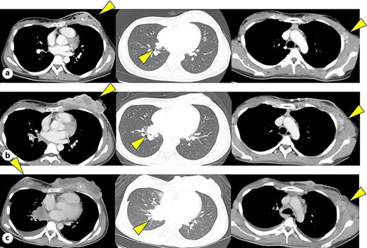 a Computed tomography (CT) taken after 4 months of adjuvant chemotherapy with S-1. Local recurrence in the left breast and metastasis to the lung and left axillary lymph node were found. b CT before treatment with entrectinib. There was progressive enlargement of the local recurrence in the left breast and multiple lung metastases. c CT scan after percutaneous pericardiocentesis and pericardial drain placement. Enlargement of existing lesions and the appearance of new lesions in the contralateral breast and skin were seen.