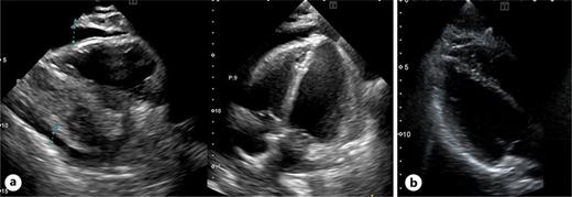 a Image from the patient’s transthoracic echocardiography (TTE) at the time of hospitalization, demonstrating circumferential pericardial effusion, and diastolic right atrial and ventricular collapse. b TTE 16 days after pericardiocentesis showing resolution of the pericardial effusion.