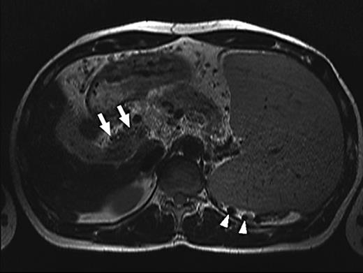 Fig. 1. T2-weighted turbo spin-echo image in axial orientation showing splenomegaly, cavernous transformation of the portal vein (white arrows) and varices (white arrowheads).