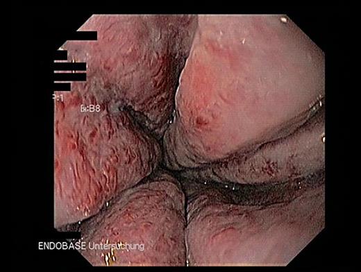 Fig. 2. Third-degree oesophageal varices with red spots. Varices exceed 50% of the intestinal lumen.