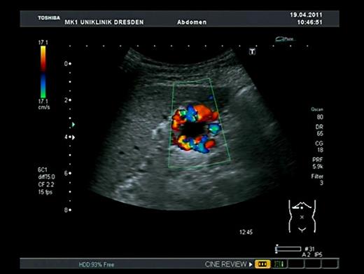 Fig. 3. Cavernous transformation of the portal vein on abdominal ultrasound.