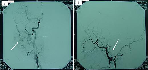 Fig. 2. DSA. a Soft tissue mass in the right parotid gland, with a rich blood supply from branches of the right external carotid artery. The arrow indicates the abnormal blood vessels. b Immediate postinjection angiography shows no visualization of the focus. The arrow indicates the disappearance of the abnormal blood vessels.