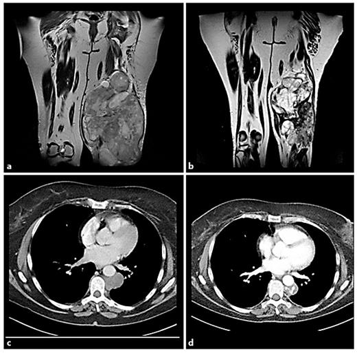Fig. 1. Change in tumor pattern. MRI before chemotherapy (a), MRI after chemotherapy (b), CT scan before chemotherapy (c) and CT scan after chemotherapy (d).