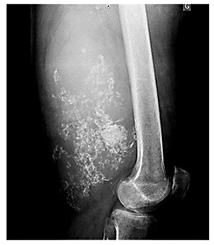 Fig. 3. Calcified primary tumor (standard X-ray).