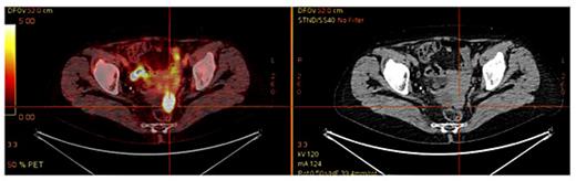 Fig. 2. [18F]FDG-PET/CT (2013): isolated abnormal uptake of FDG (SUVmax 8.4) in a pelvic posterior mass just before the rectum.
