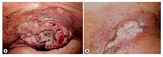 Fig. 2. Macroscopic findings of the left inguinal region. a A large inguinal mass with an ulcer, exudates, and bleeding was observed at the initial visit. b Macroscopic findings improved 39 days after the initiation of multimodal treatment.