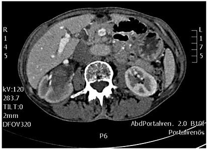Fig. 1. Computed tomography, portal venous phase: tumor of about 5cm in diameter filling out the right pyelon and showing slow contrast enhancement.
