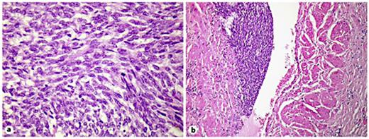 Fig. 2. a Typical fascicles of mitotically active spindle-shaped cells of monophasic synovial sarcoma. b Tumor cells invading into a blood vessel lumen.