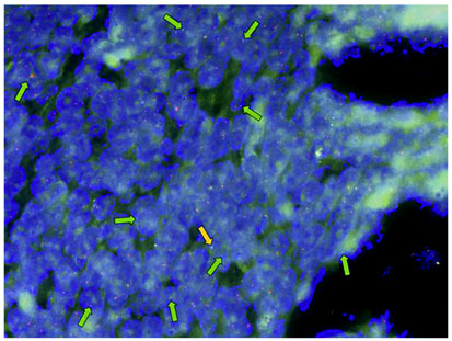 Fig. 3. FISH-testing revealing SYT gene rearrangement: some cells show a normal signal with yellow fusion signals (orange arrow), reflecting nonrearranged alleles. The majority of cells, however, show a pathological signal pattern with separated orange and green signals (green arrows) indicative of a rearrangement.