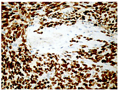 Fig. 4. TLE1 appears to be strongly predictive of a SYT gene rearrangement, and it is especially helpful in poorly differentiated synovial sarcomas where the expression of the protein may be even stronger.