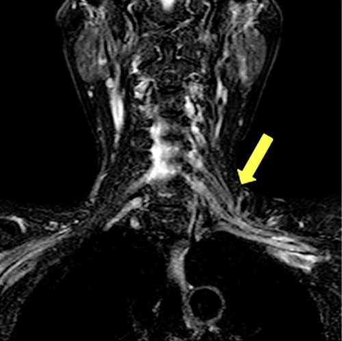 Fig. 1. STIR MRI showed no abnormalities.