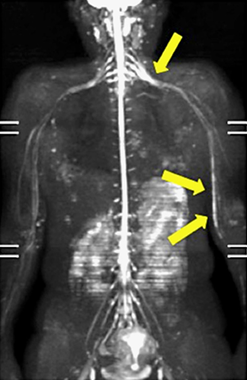 Fig. 2. MR neurography revealed a swollen region in the left brachial plexus.