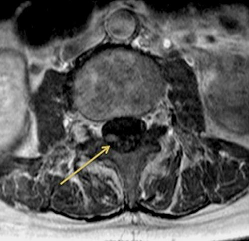 Fig. 3. Enhanced lumbar MRI showed the swelling of the cauda equina.